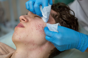 Clearing the Slate: The Ultimate Guide to the Best Acne Scar Treatments
